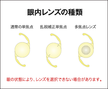 眼内レンズの種類